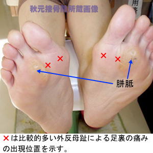 外反母趾で見られる足裏の症状