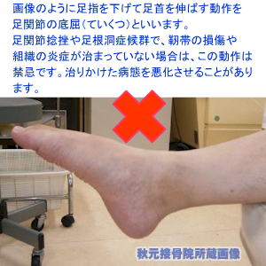 足の外くるぶしの痛み しびれ 足根洞症候群