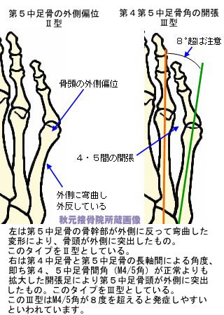 足 の 小指 の 付け根 が 痛い