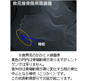 こどものかかとの痛み 踵骨骨端症 シーバー病