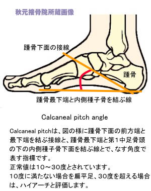 Calcaneal_pitch_angle