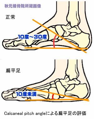 Calcaneal_pitch_angle̝G]