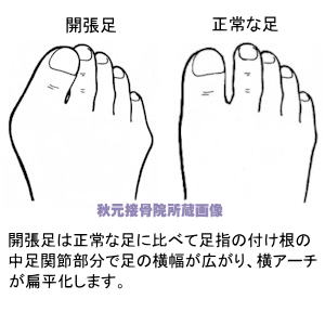 足 の 指 の 付け根 の 痛み
