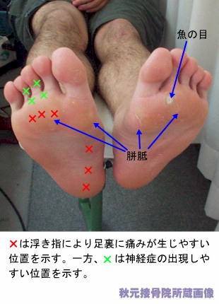 浮き指 症状 原因 改善法