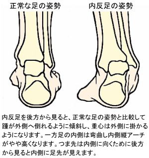 の が 付け根 小指 痛い 足 の 足の小指が痛い原因と対策のまとめ