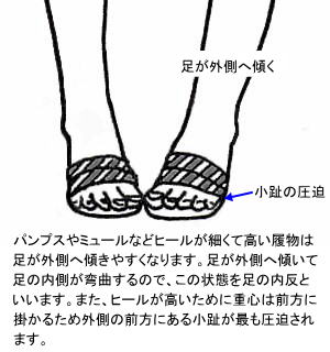 内反小趾 バニオネット 足の小指の付け根の痛み 腫れ