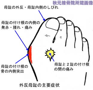 足の親指付け根の腫れ 痛み 外反母趾と病気の見分け方