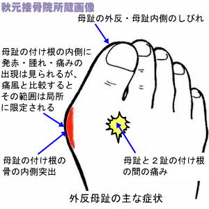 足の親指付け根の腫れ 痛み 外反母趾と病気の見分け方