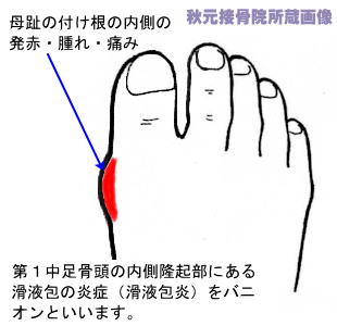 足 の 親指 の 付け根 痛み