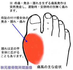 腫れる が 足 親指 の