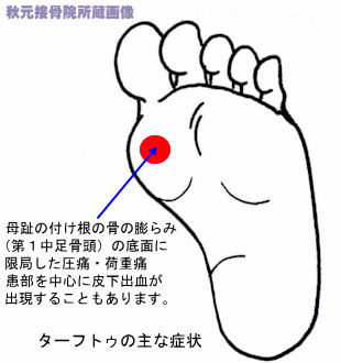 足の親指付け根の腫れ 痛み 外反母趾と病気の見分け方