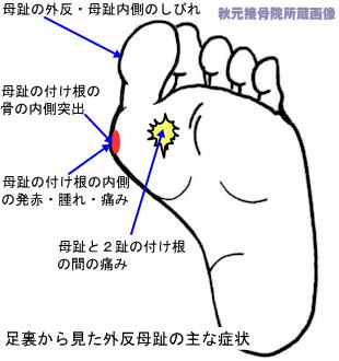 足の親指付け根の腫れ 痛み 外反母趾と病気の見分け方