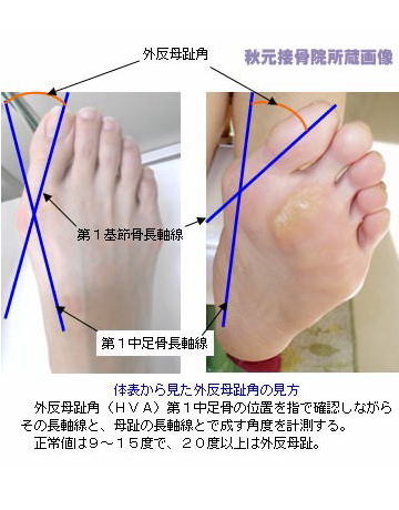 足の親指付け根の腫れ 痛み 外反母趾と病気の見分け方