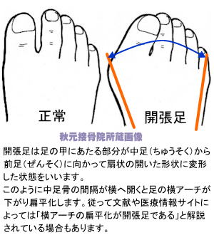 開張足 足幅が広がる原因