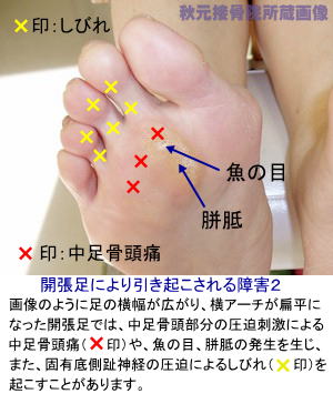 開張足 足幅が広がる原因