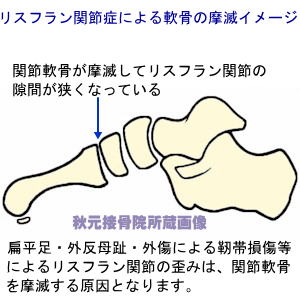 リスフラン関節症による軟骨の摩滅