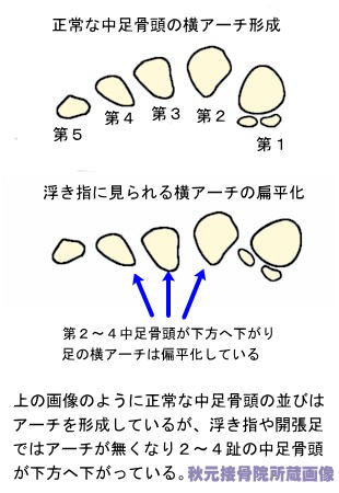 浮き指 症状 原因 改善法