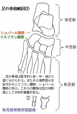 足の甲の痛み 腫れ リスフラン関節症