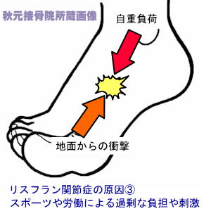 足の甲の痛み 腫れ リスフラン関節症
