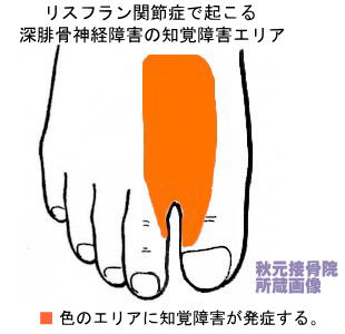 リスフラン関節症の深腓骨神経障害