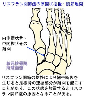 内側 楔状 骨