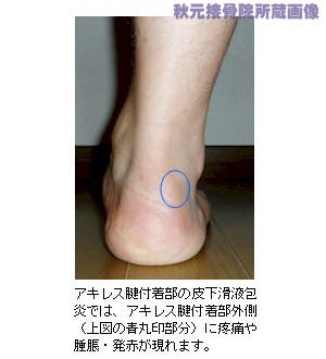 皮下滑液包炎の症状出現位置