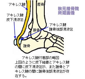 踵やアキレス腱の痛み 靴擦れ ハグルンド病