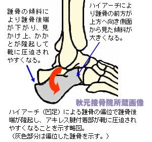 踵やアキレス腱の痛み 靴擦れ ハグルンド病