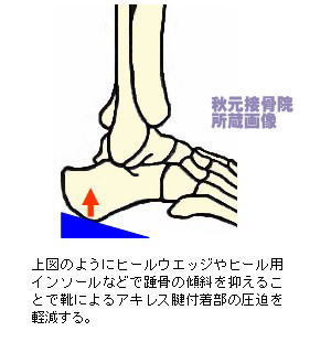 ヒールウェッジによる治療法