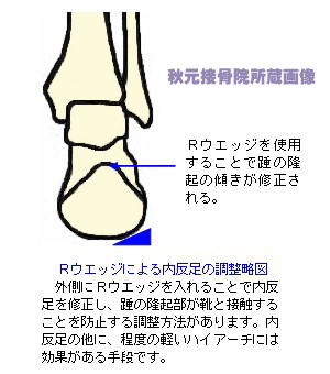 Ｒウェッジによる内反足の調整略図
