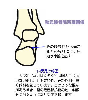 内反足の略図