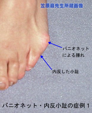 腫れ 足の指の付け根 足の裏の腫れの原因とは？もしかしたら病気かも？