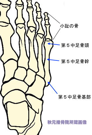 足 小指 の 付け根 痛い