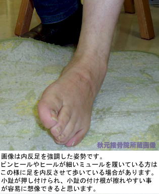 内反小趾 バニオネット 足の小指の付け根の痛み 腫れ