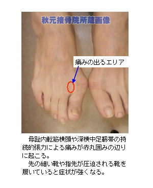 外反母趾とは 原因 治し方