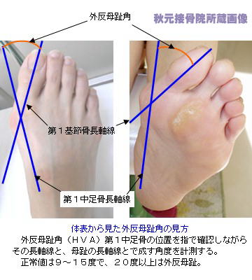 外反母趾とは 原因 治し方